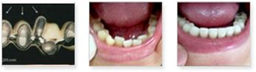 玻璃离子补牙后的护理该怎么做