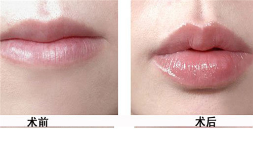 绍兴唇腭裂矫正手术的副作用有什么